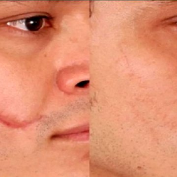 Tatouage auf den Narben