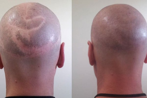 Tatouage auf den Narben